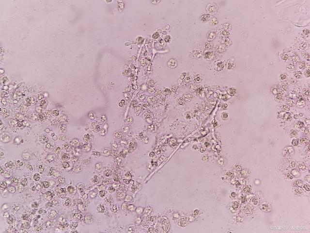 白色念珠菌在临床上相当常见,又叫作白假丝酵母菌.